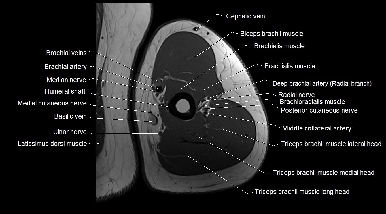 Upper arm( humerus) cross section anatomy MRI 3T axial image 38.webp